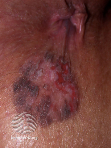 Intraepidermal carcinoma (DermNet NZ lesions-scc-in-situ-2981).jpg