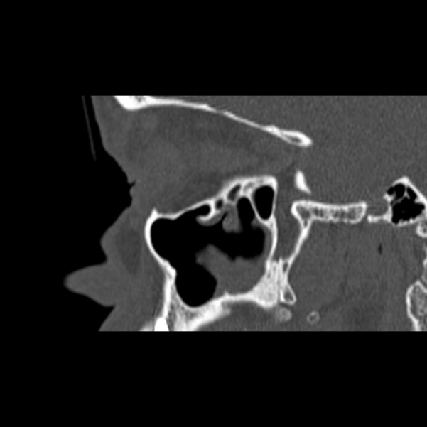 Nasal septal perforation (Radiopaedia 25030-25289 Sagittal bone window 5).jpg