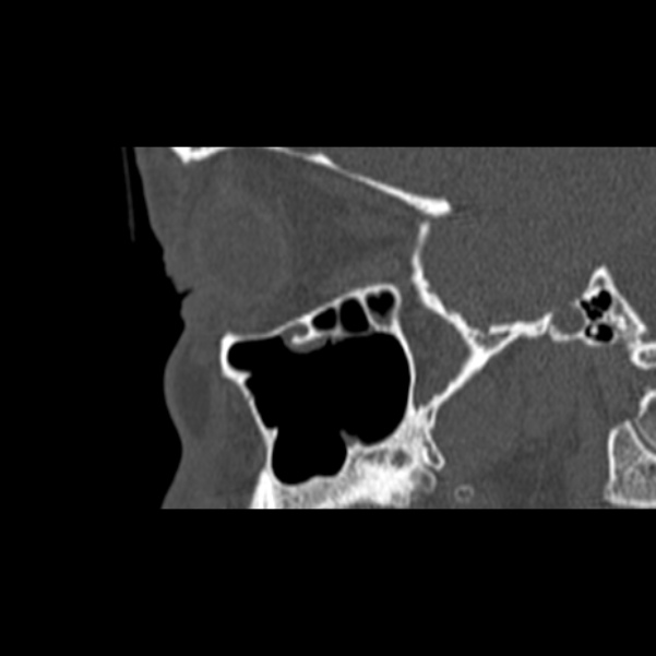 Nasal septal perforation (Radiopaedia 25030-25289 Sagittal bone window 56).jpg