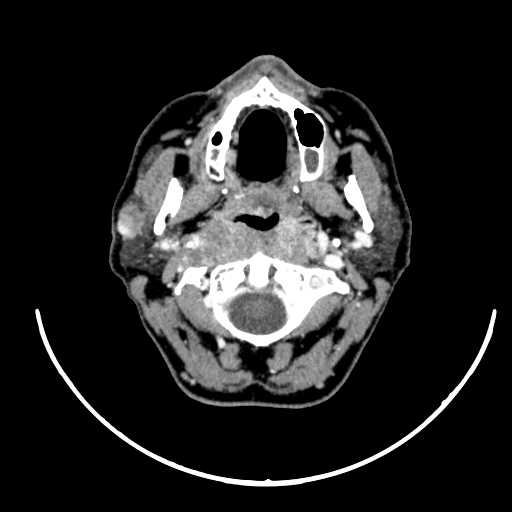 File:Nasopharyngeal carcinoma - infiltrating the clivus (Radiopaedia 62583-70875 Axial Post contrast 23).jpg