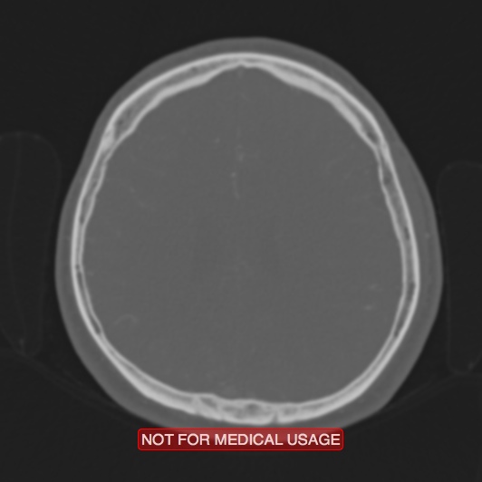 Nasopharyngeal carcinoma recurrence - skull base destruction (Radiopaedia 29107-29490 Axial bone window 35).jpg