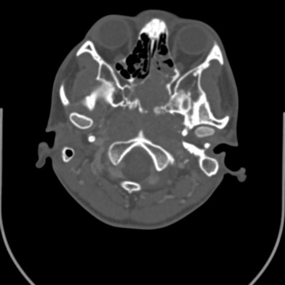 Nasopharyngeal carcinoma with skull base invasion (Radiopaedia 53415-59705 Axial bone window 29).jpg