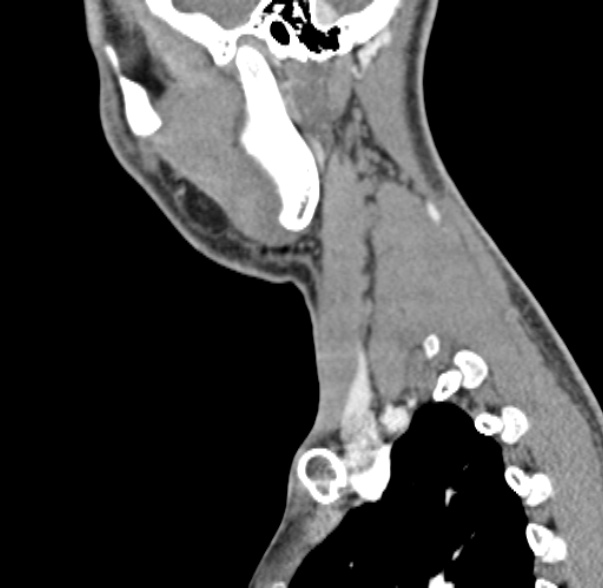 Nasopharyngeal carcinoma with skull base invasion (Radiopaedia 53415-59705 C 12).jpg