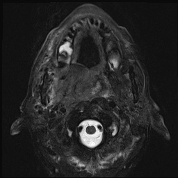 File:Nasopharyngeal carcinoma with skull base invasion (Radiopaedia 59258-66600 D 25).jpg