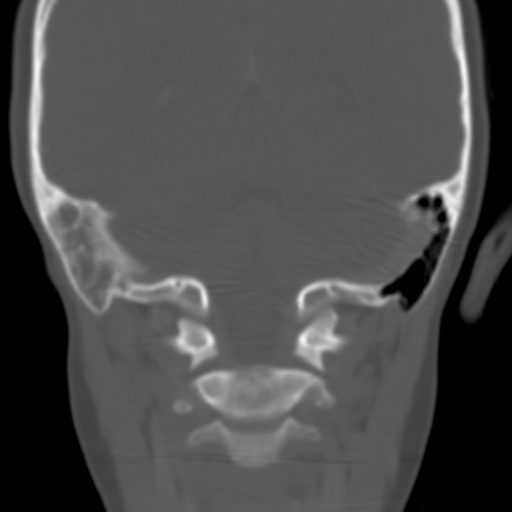 File:Nasopharyngeal rhabdomyosarcoma (Radiopaedia 23417-23491 Coronal bone window 12).jpg