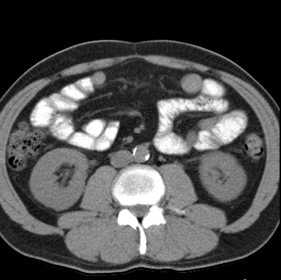 File:Necrotizing pancreatitis with acute necrotic collection (Radiopaedia 14470-14417 Axial non-contrast 27).jpg