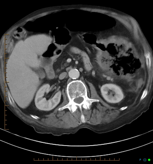 Necrotzing fasciitis due to a perforated adenocarcinoma of the splenic flexure (Radiopaedia 46930-51455 A 29).jpg