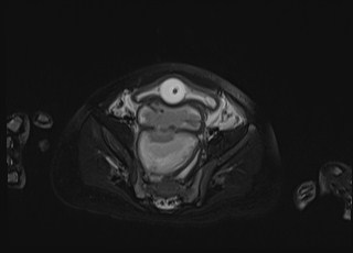 Neonatal prostatic utricle abscess - cyst (Radiopaedia 69511-79394 Axial T2 fat sat 23).jpg