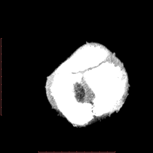 File:Neuroblastoma skull metastasis (Radiopaedia 56053-62683 Axial non-contrast 16).jpg