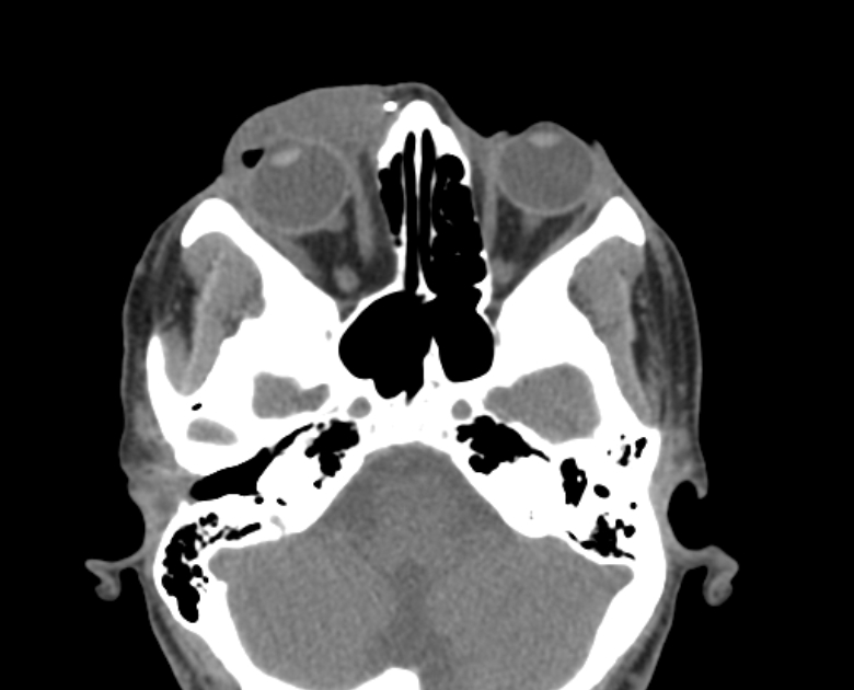 Neurofibromatosis type 1- orbital manifestations (Radiopaedia 49391-54511 Axial non-contrast 45).jpg