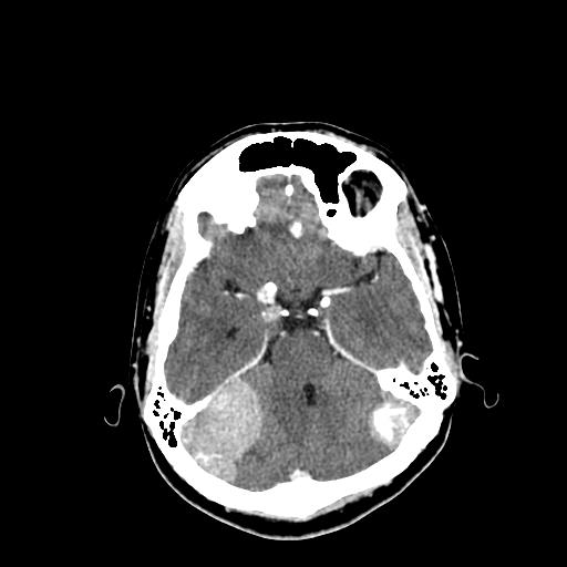 File:Neurofibromatosis type 2 (Radiopaedia 25389-25637 Axial C+ 24).jpg