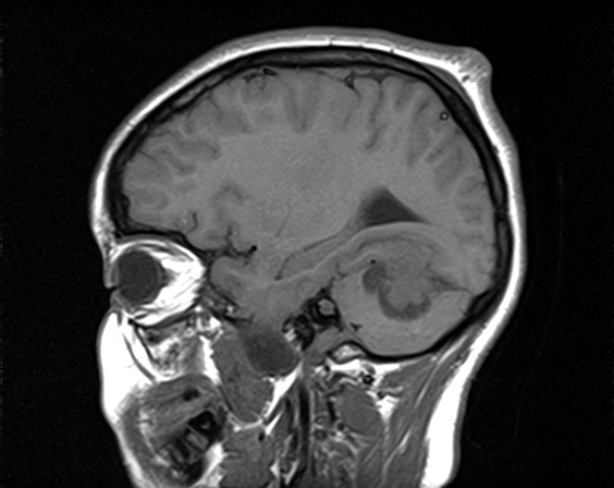 File:Neurofibromatosis type 2 (Radiopaedia 66211-75401 Sagittal T1 8).jpg
