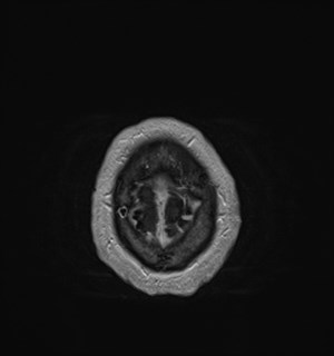 Neurofibromatosis type 2 (Radiopaedia 79097-92049 Axial T1 C+ 181).jpg
