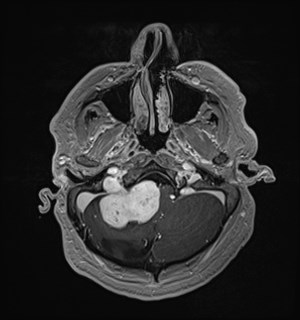 Neurofibromatosis type 2 (Radiopaedia 79097-92049 Axial T1 C+ 43).jpg