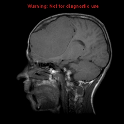 File:Neurofibromatosis type 2 (Radiopaedia 8953-9730 Sagittal T1 13).jpg