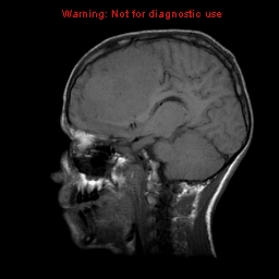 File:Neurofibromatosis type 2 (Radiopaedia 8953-9730 Sagittal T1 9).jpg