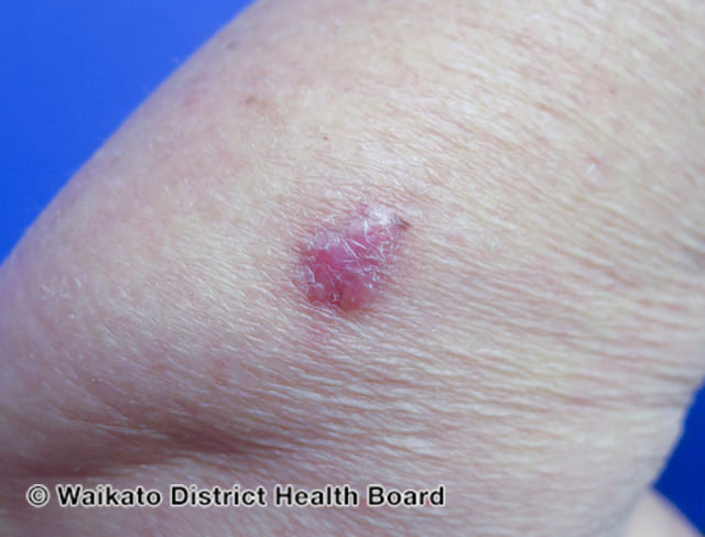 File:Nodular basal cell carcinoma, arm (DermNet NZ nbcc-arm-20-wdhb).jpg