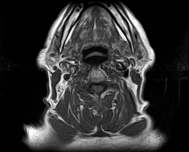File:Non-Hodgkin lymphoma - parotid gland (Radiopaedia 71531-81890 Axial T1 7).jpg