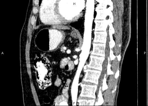 Non-syndromic pancreatic endocrine tumor (Radiopaedia 86958-103178 E 58).jpg