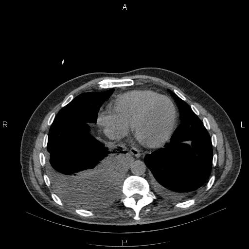 File:Non Hodgkin lymphoma in a patient with ankylosing spondylitis (Radiopaedia 84323-99624 Axial non-contrast 25).jpg