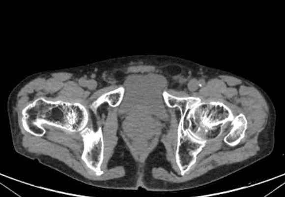 File:Nondisplaced incomplete intertrochanteric fracture (Radiopaedia 73736-84539 Axial soft tissue 64).jpg