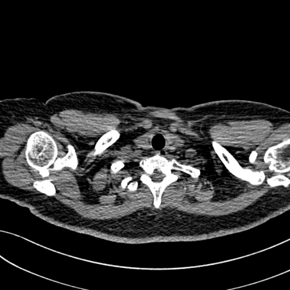 Normal CT chest- adult female (Radiopaedia 52522-58428 Axial non-contrast 10).jpg