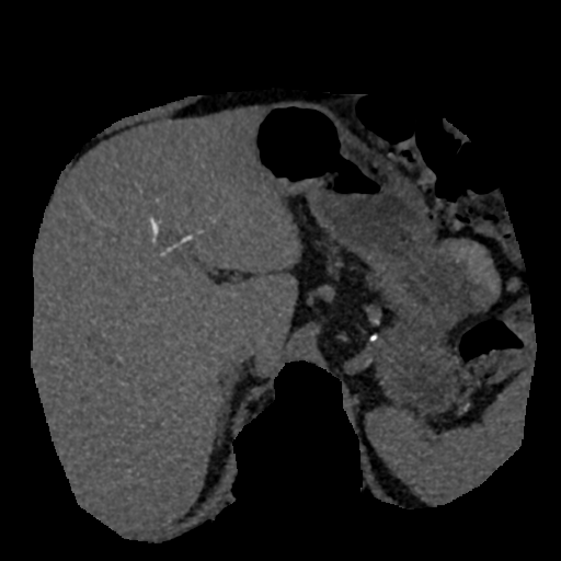 File:Normal CT intravenous cholangiogram (Radiopaedia 38199-40208 Axial IVC (MIP) 64).png