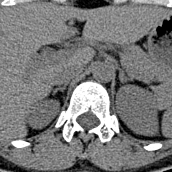 Normal CT lumbar spine (Radiopaedia 53981-60118 Axial non-contrast 3).jpg
