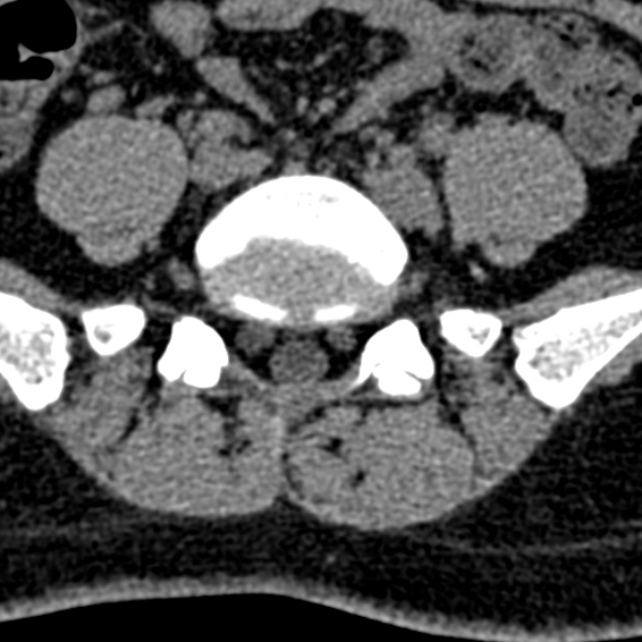 Normal CT lumbar spine (Radiopaedia 53981-60118 Axial non-contrast 85).jpg