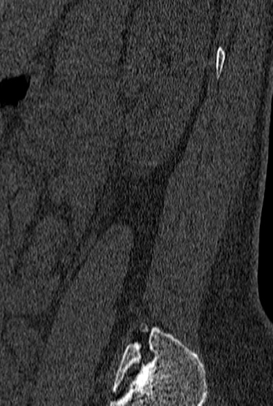 File:Normal CT lumbar spine (Radiopaedia 53981-60118 Sagittal bone window 89).jpg