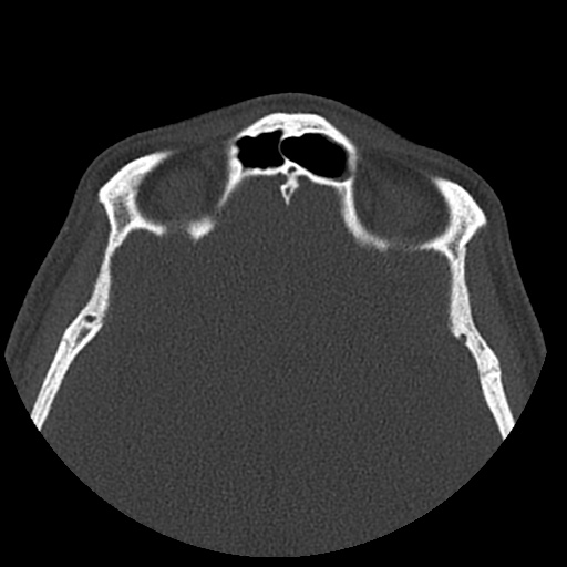 Normal CT paranasal sinuses (Radiopaedia 42286-45390 Axial bone window 30).jpg