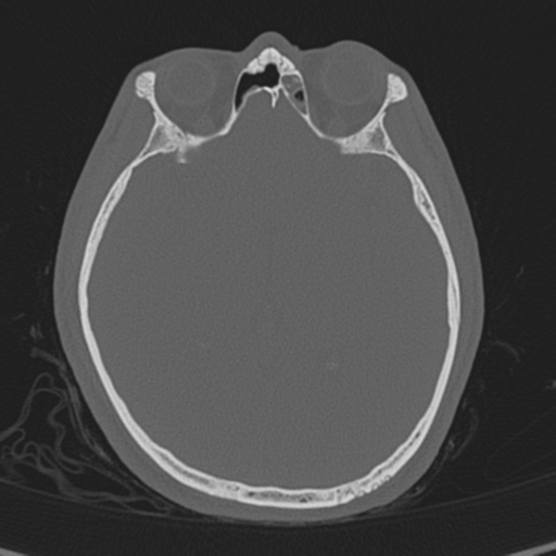 Normal CT skull (Radiopaedia 40798-43459 A 74).png
