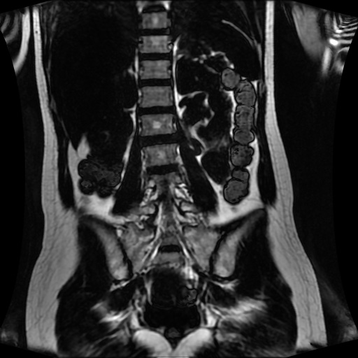 Normal MRI abdomen in pregnancy (Radiopaedia 88001-104541 N 93).jpg