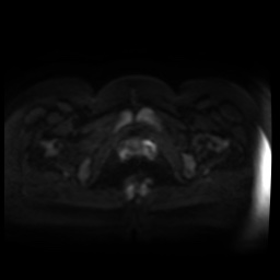 Normal MRI abdomen in pregnancy (Radiopaedia 88005-104548 Axial DWI 80).jpg