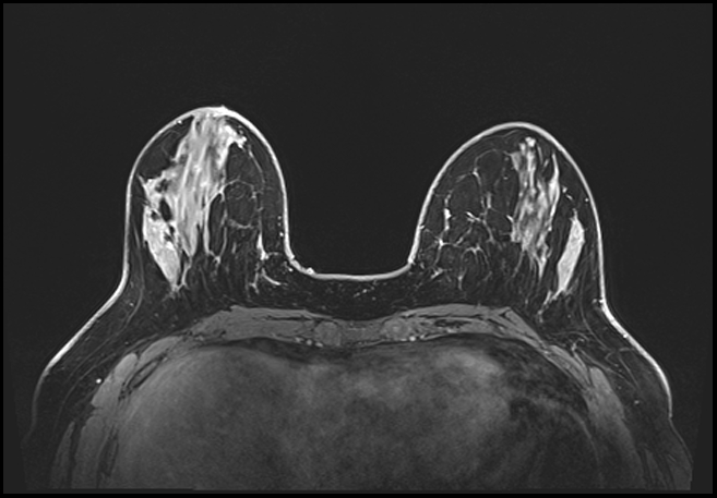 Normal breast MRI - dense breasts (Radiopaedia 80454-93850 C 75).jpg