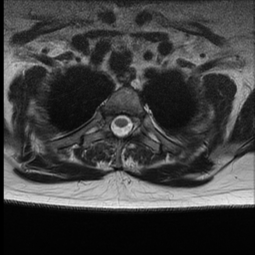 File:Normal cervical and thoracic spine MRI (Radiopaedia 35630-37156 H 38).png
