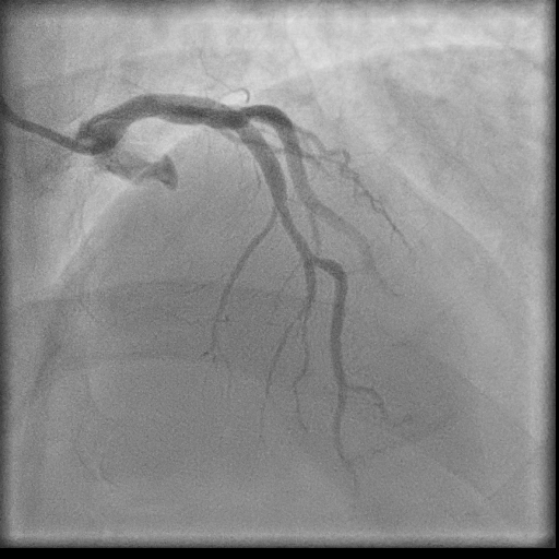 Normal coronary angiogram (DSA) (Radiopaedia 63081-71571 E 25).jpg
