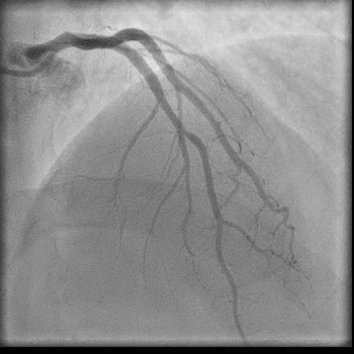 Normal coronary angiogram (DSA) (Radiopaedia 63081-71571 E 44).jpg