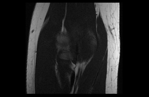 File:Normal elbow arthrograms (Radiopaedia 75550-86805 Coronal T1 12).jpg