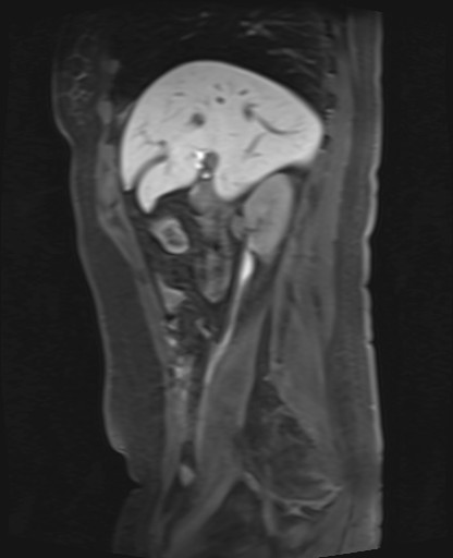 File:Normal hepatobiliary phase liver MRI (Radiopaedia 58968-66230 C 28).jpg