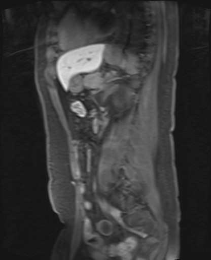 File:Normal hepatobiliary phase liver MRI (Radiopaedia 58968-66230 C 49).jpg