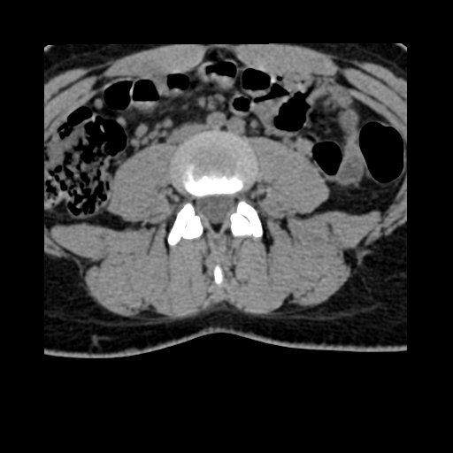 File:Normal lumbar spine CT (Radiopaedia 46533-50986 C 1).png