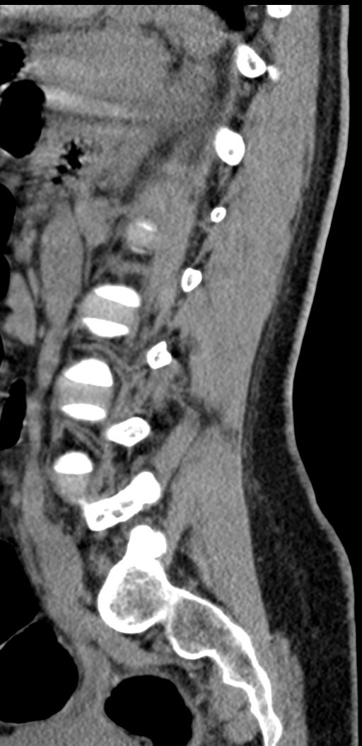 Normal lumbosacral CT (Radiopaedia 37923-39867 E 40).png