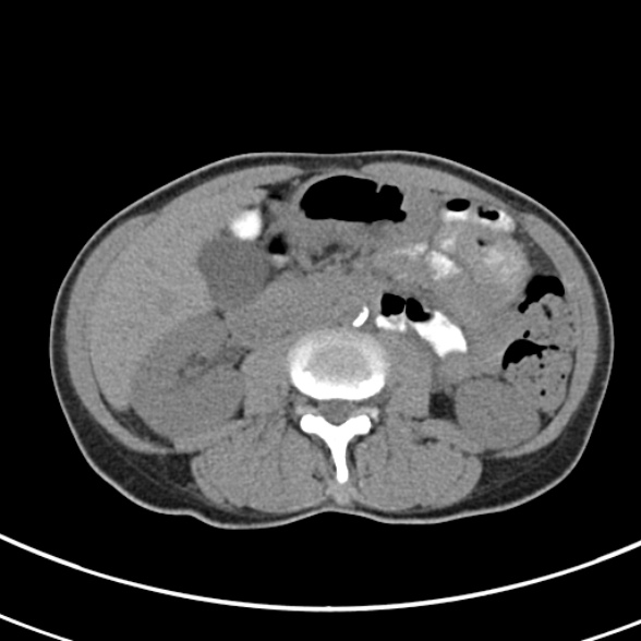 File:Normal multiphase CT liver (Radiopaedia 38026-39996 Axial non-contrast 39).jpg
