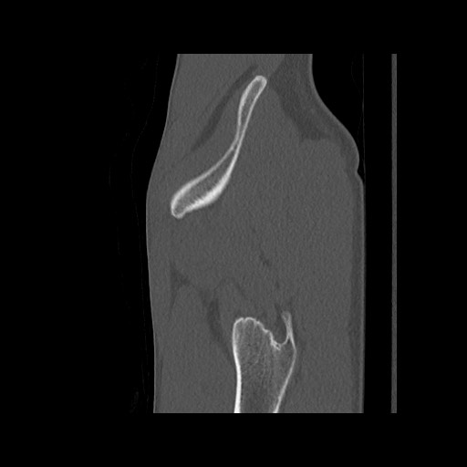 Normal pelvis (Radiopaedia 51473-57238 Sagittal bone window 130).jpg