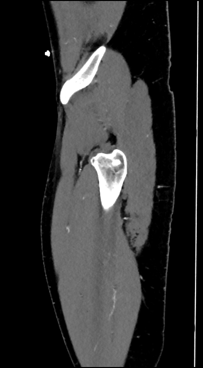 Normal pelvis CT angiogram (Radiopaedia 84966-100481 C 98).jpg