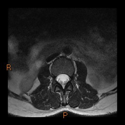 File:Normal spine MRI (Radiopaedia 77323-89408 Axial T2 1).jpg