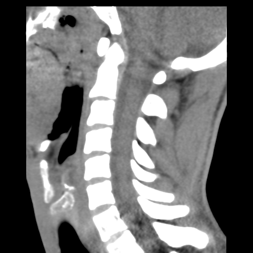 File:Normal trauma cervical spine (Radiopaedia 41017-43760 B 16).png