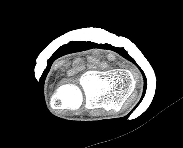 Normal wrist CT (Radiopaedia 41425-44297 Axial non-contrast 37).png