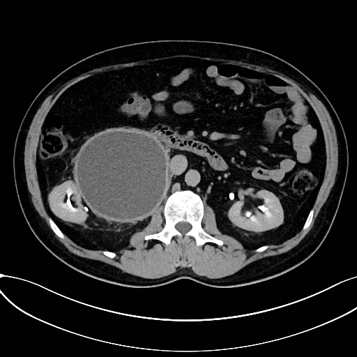 Obstructed upper pole ureter in a duplex kidney (Radiopaedia 54935-61221 Axial C+ delayed 27).jpg